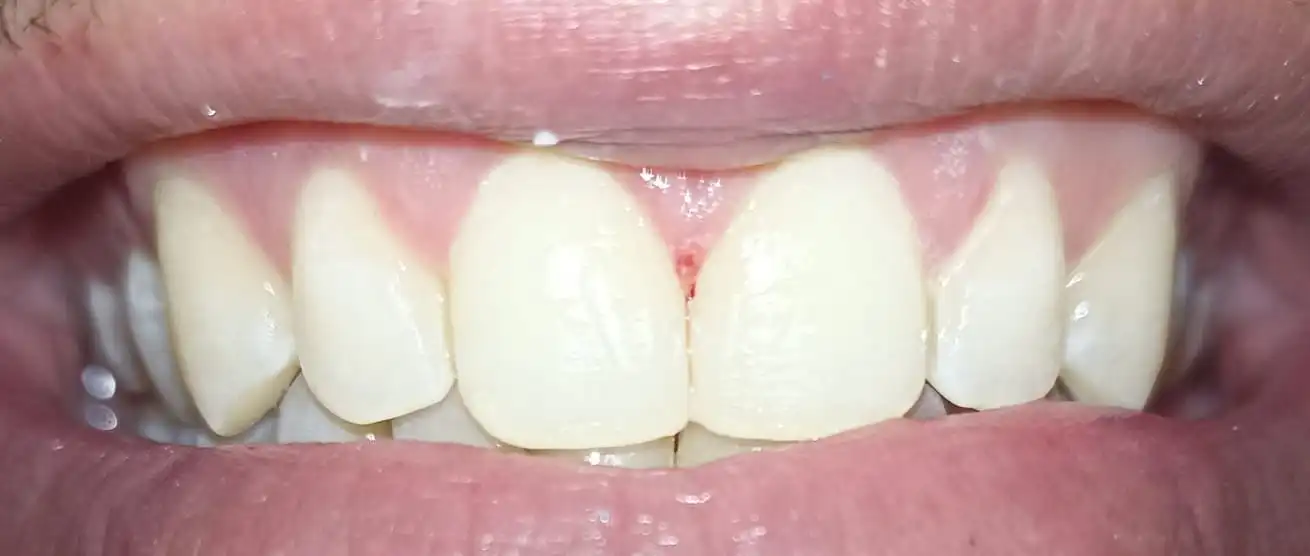 Después del diseño de sonrisa